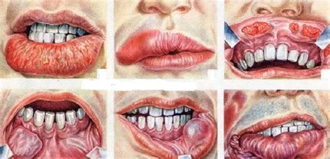 As you review these images and their descriptions, you will be. Oral Cancer | Modern Cancer Hospital Guangzhou, China
