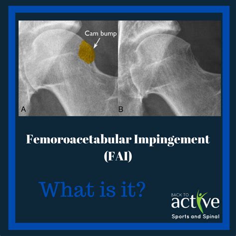 Femoroacetabular Impingement Fai Back To Active Sports And Spinal