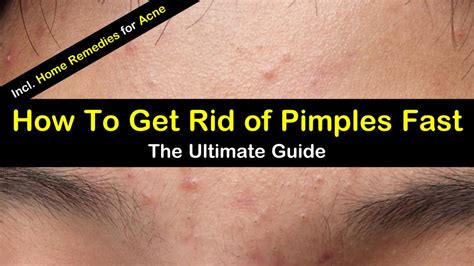 8 Great Home Remedies To Get Rid Of Pimples Fast