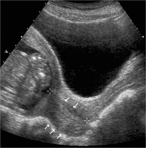 Is Transabdominal Sonography Of The Cervix After Voiding A Reliable