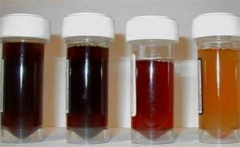 Saiba o que a ciência já descobriu sobre a doença da urina preta WSCOM