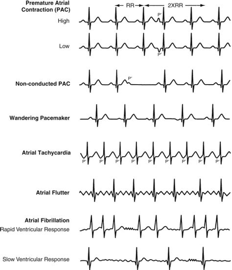 Cardiac Arrhythmias Thoracic Key