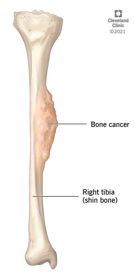 Osteosarcoma Knee Tumor