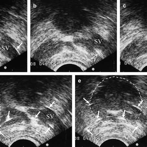 A Transrectal Ultrasonography Visualized The Seminal Vesicles Svs