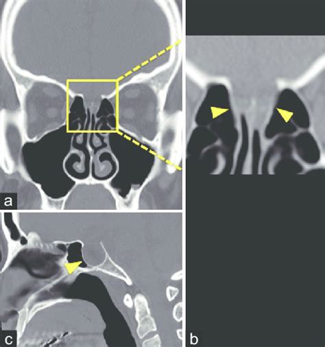 High Resolution Computed Tomography Ct Reveals Enlargement Of The