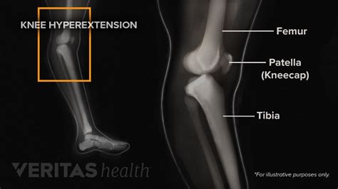 Diagnosing Knee Hyperextension