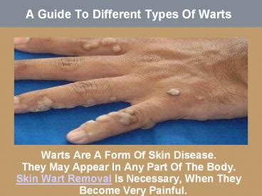 PPT A Guide To Different Types Of Warts PowerPoint Presentation