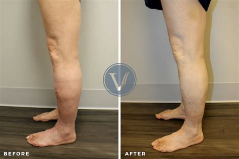 Treatment For Dvt And Varicose Veins The Vein Institute At Ssa