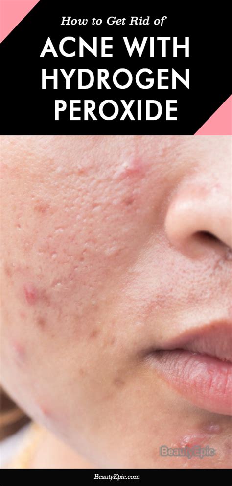 how to use hydrogen peroxide for acne