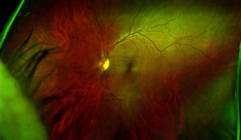 Discoveries In Medicine New Approach To Treating Neurodegenerative Eye