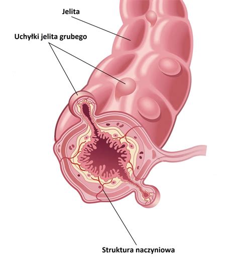 Czym są uchyłki jelita grubego Jak wyglądają i jak je leczyć Sprawdzone