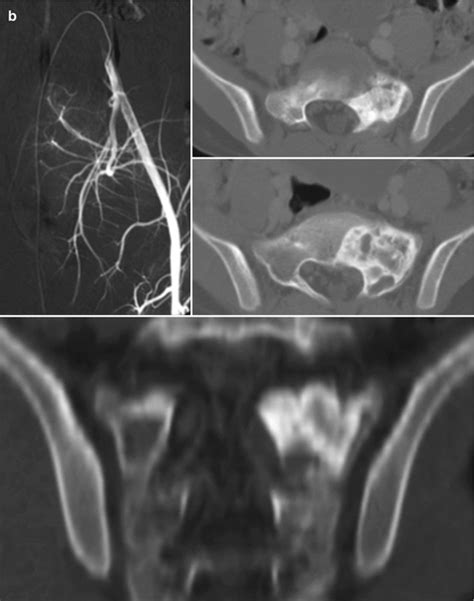 Aneurysmal Bone Cyst Of The Sacrum Radiology Key