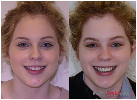 Facial Growth And Airways Kaleen Dental Care And Facial Aesthetics