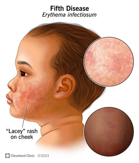 Fifth Disease Erythema Infectiosum Symptoms Causes Treatment