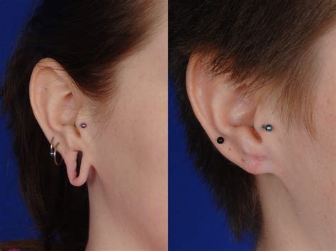 Before And After Earlobe Repair And Ear Surgery Photos