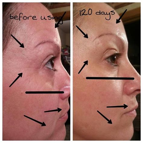 Look How Amazing These Results Are Try Nerium For Yourself