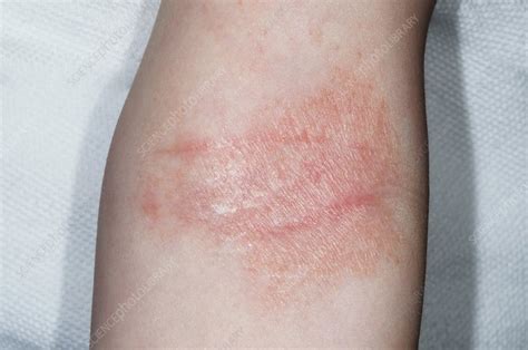 How To Treat Eczema On Elbows