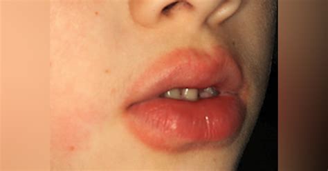 Child Swollen Lip After Dental Work