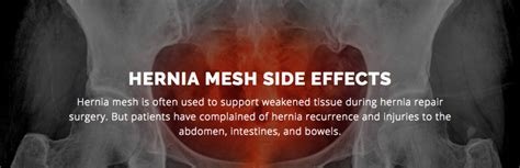 Hernia Mesh Side Effects Holistic Hernia Remediation