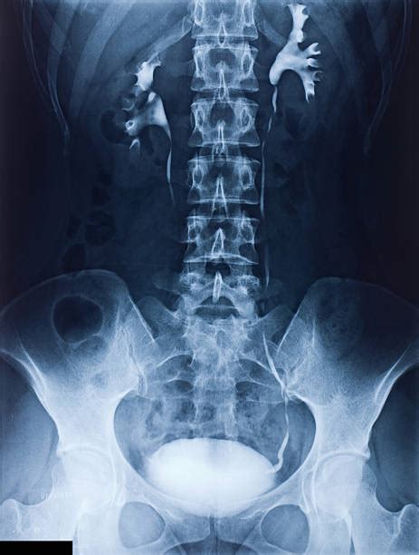 20 Pelvis X Ray Image Human Bone Ileum Stock Photos Pictures