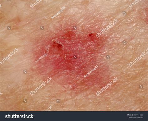 Case Ulcerated Superficial Basal Cell Carcinoma Foto De Stock Editar