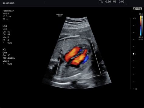 Ultrasound Images Fetal Heart Color Doppler Echogramm №787