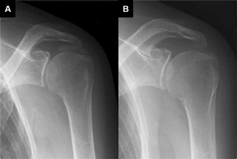 Plain Radiographs Of Acute Calcific Tendinitis Of The Rotator Cuff A Hot Sex Picture