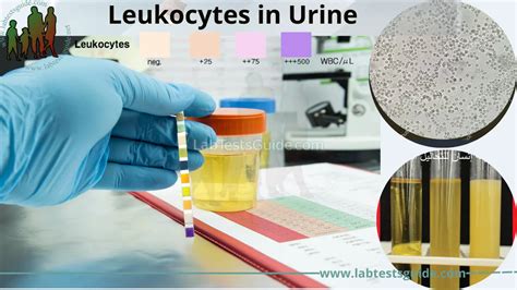 Leukocytes In Urine Test Lab Tests Guide