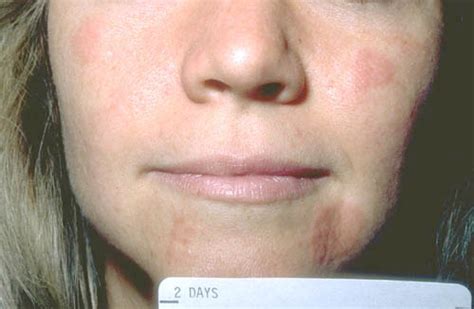 Home Remedy For Candida On Skin Candidiasis On Face