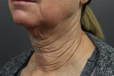 Non Surgical Necklift Before And After Gallery Patient 2