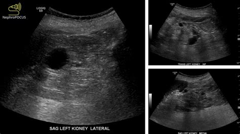 Multiple Cysts In The Kidneys Nephropocus