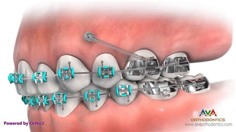 Temporary Anchorage Device Tad Orthodontic Device Orthodontics Mini Implants Orthodontic