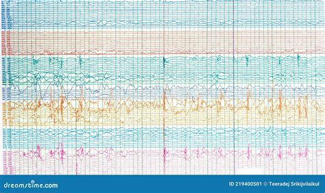 Photography Of Brain Waves Of Epileptic Patient Showing Sharp Wave