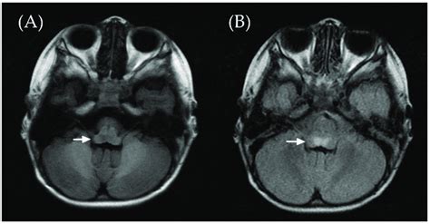 Brain Magnetic Resonance Imaging Showed Symmetric Lesions Involving The