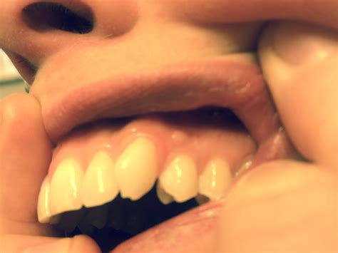Small chips, a bump on the roof of your mouth, or even a tiny ulcer under your tongue are easy to pick out from the healthy or normal oral tissues around them. Bumps On Gums In Mouth - Female Sex Images
