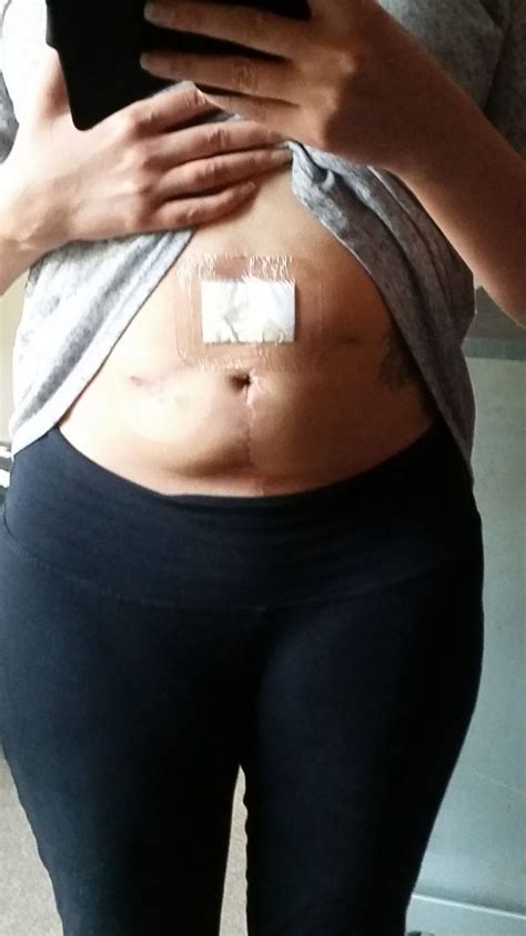 6 Weeks Post Colostomy Reversal Op I Survived