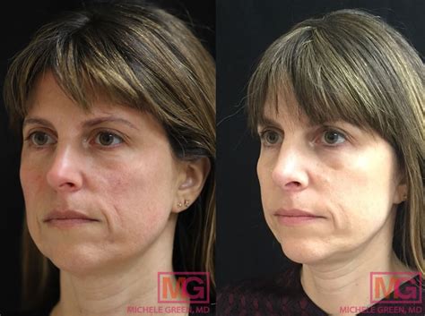 Treatments For Sagging Jowls Saggy Jowl Causes And Exercises Dr