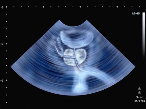 Transrectal Ultrasound Preparation Procedure Cost And More