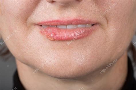 Sexual contact with hsv 2 individuals. Lábio de infecção com o vírus da herpes — Fotografias de ...