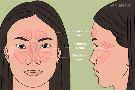 Sinus Surgery For Chronic Rhinosinusitis With Nasal Polyps Ent Uk