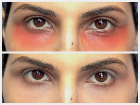Surprisingly though, i've started to embrace them…with one minor setback. How to: Use Red Lipstick to Cover/Hide/Mask Dark Under Eye ...