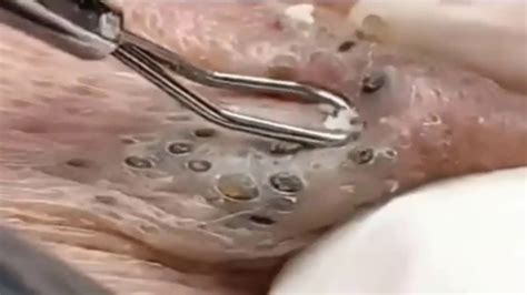 Deep Blackhead Extraction Cystic Acne And Pimple Popping 28 Youtube