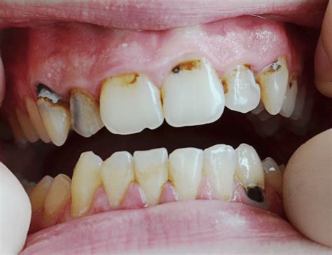 Gum Disease Treatment Dentist In Duncanville Minty Smiles