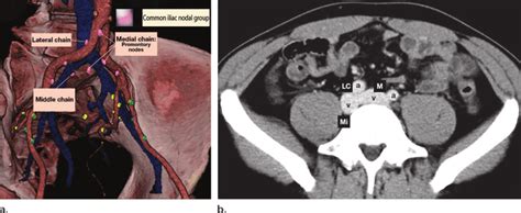 Iliac Fossa