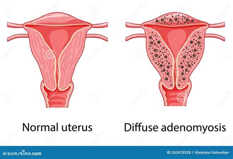 Endometrioma Endometrial Cyst Cartoon Vector Cartoondealer Hot Sex Picture
