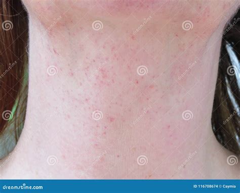 None Fading Rash On Neck Caused By Vomiting Stock Photo Image Of
