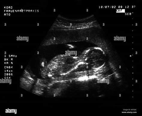 Ultrasound Black And White Stock Photos And Images Alamy