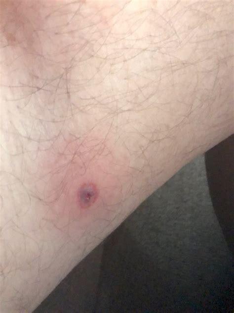 What Do Tick Bites Look Like On The Skin Quora