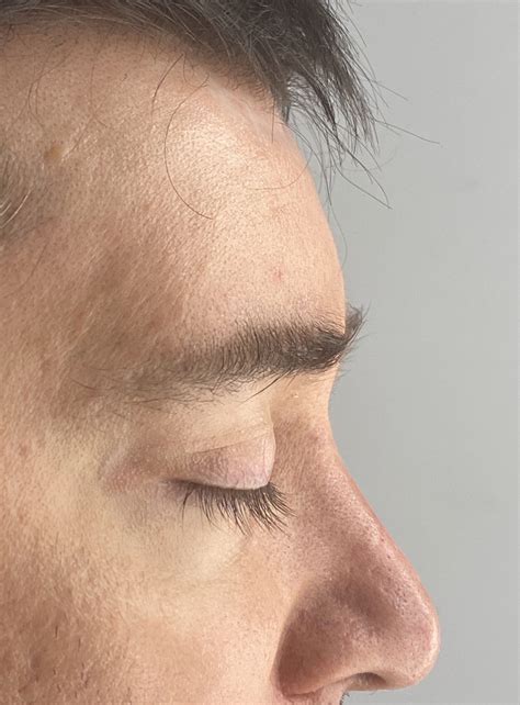 Plastic Surgery Case Study Custom Forehead Implant Augmentation In