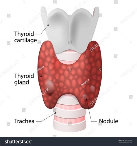 Thyroid Nodules Goiters Stock Illustration 388322500 Shutterstock